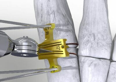 Cut guide system specifically launched to control bone resection while addressing IM reduction in a Lapidus procedure