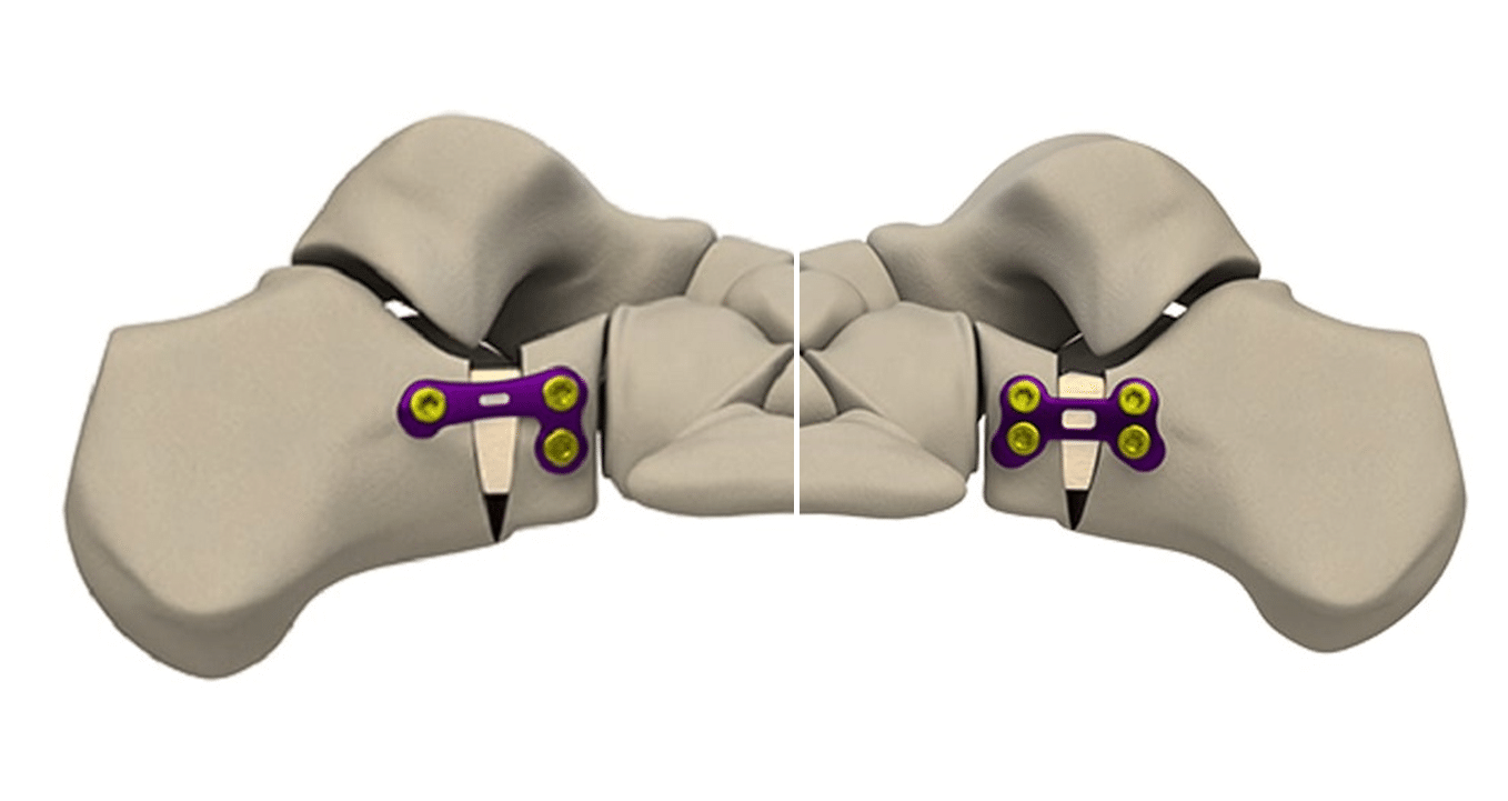 GORILLA Lisfranc/TMT Plating System BeMedical